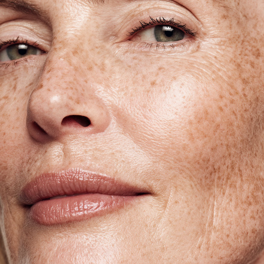 Pigmentering/ujevn hudtone