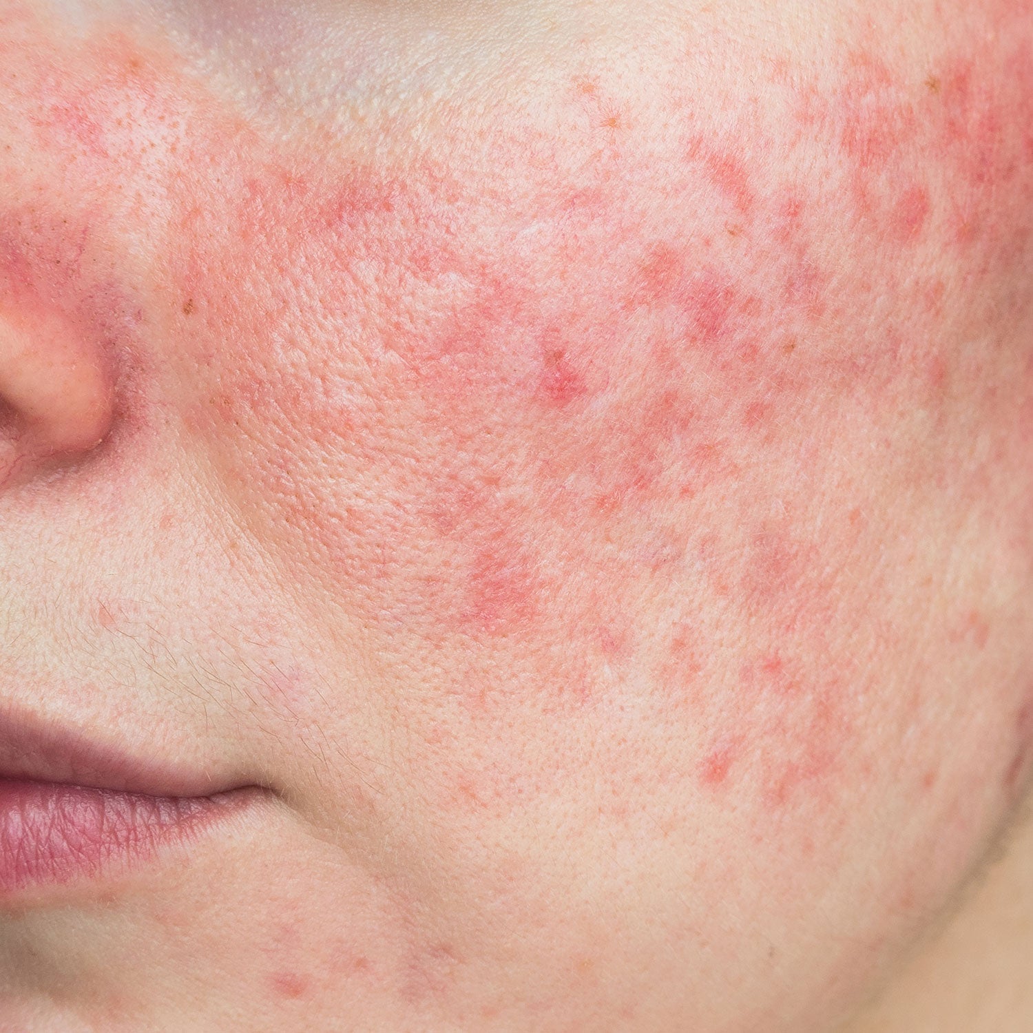 Rosacea & Rød hud